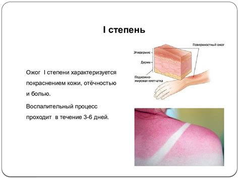 Как снять покраснение после ожога: проверенные методы и средства