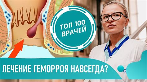 Как устранить геморрой: лечение и профилактика