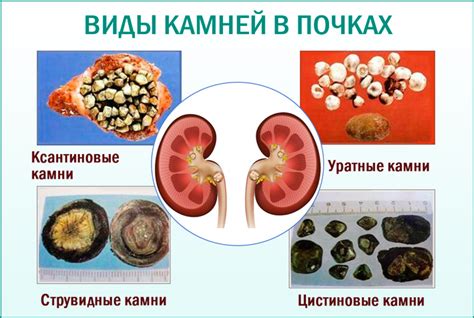 Камни почек: факторы их образования