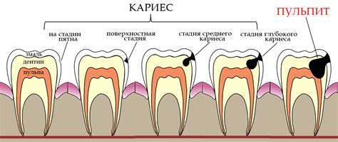 Кариес как основная причина свищей