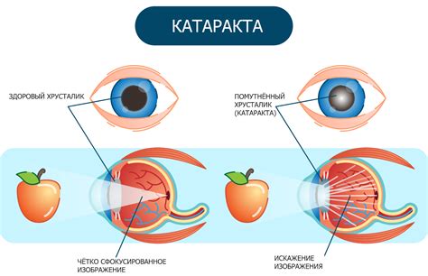 Катаракта