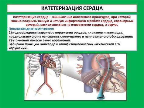 Катетеризация сердца: точный инструмент для диагностики сердечной недостаточности