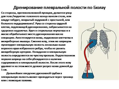 Классический метод дренажа легких