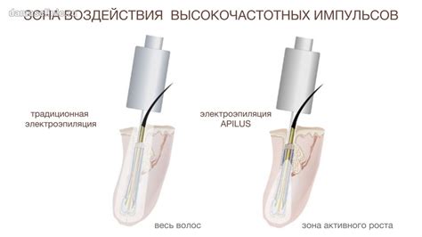 Когда ожидать видимого эффекта от электроэпиляции: факторы, влияющие на результат