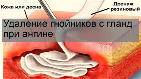 Когда хирургическое удаление гнойников является необходимым