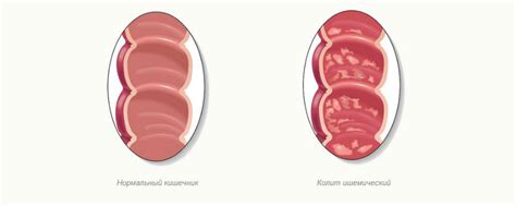 Колит: виды и факторы риска