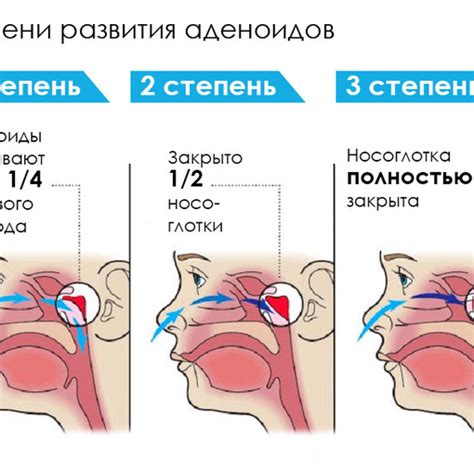 Консервативное лечение аденоидов