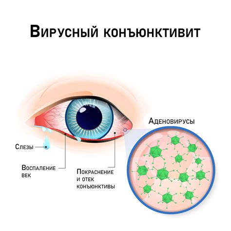 Конъюнктивит: симптомы и основные причины