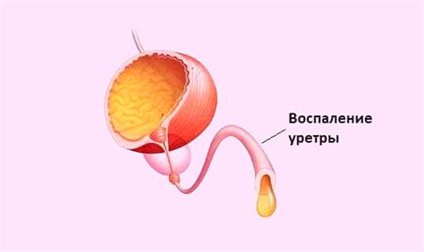 Короткая уретра у женщин