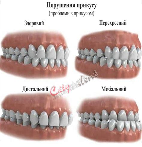 Косоусталый прикус