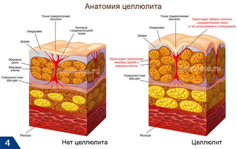 Криолиполиз: как происходит ликвидация жировых клеток