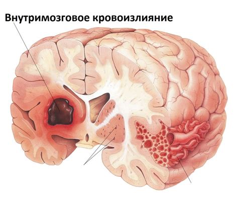 Кровотечение в мозге