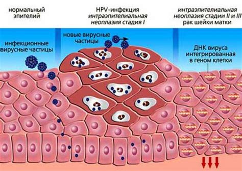 Лечение ВПЧ: основные методы