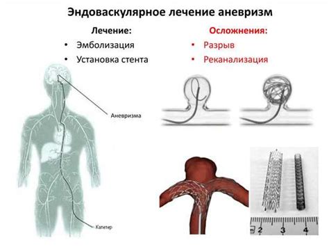 Лечение аневризмы головного мозга: методы и процедуры