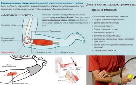 Лечение и профилактика травм локтевого сустава: полезные советы и методы