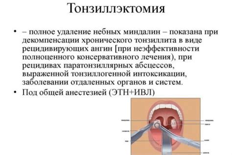 Лечение миндалин с помощью тепловых процедур