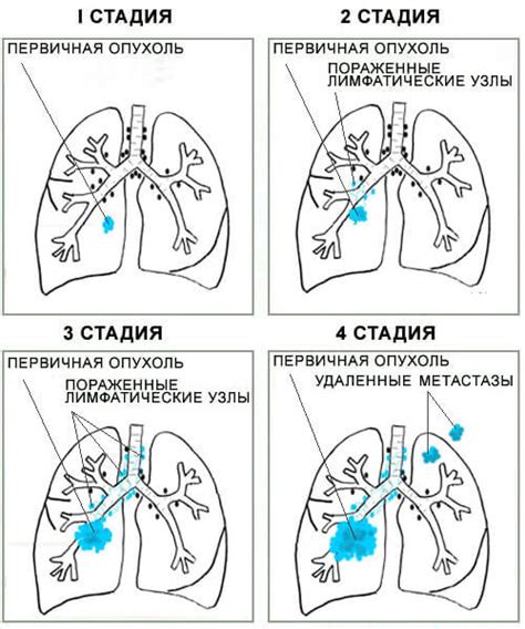 Лечение опухания лица при раке легкого