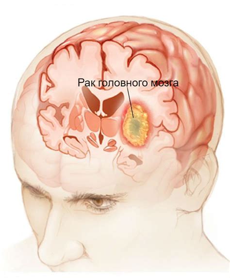 Ликворологические методы диагностики опухоли в голове