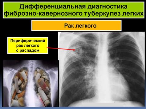 Медведи и туберкулез