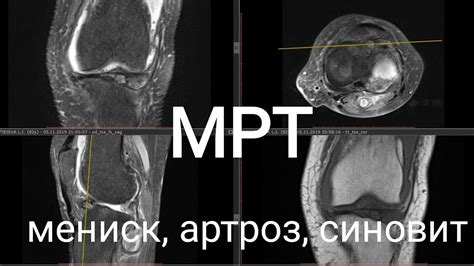 Медикаменты после операции мениска