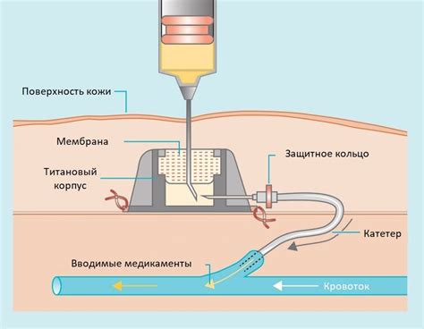 Медицинская капельница: принцип действия и составляющие