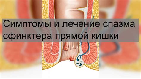 Медицинские методы лечения спазма сфинктера