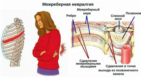 Межреберные невралгии