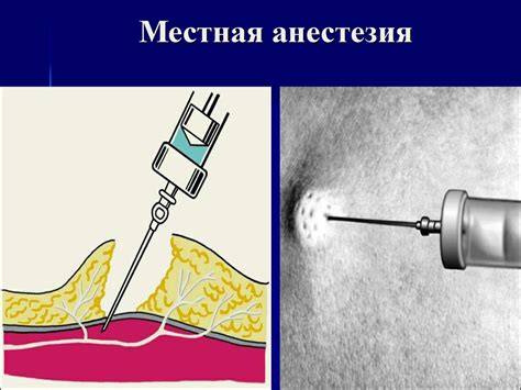 Местная анестезия