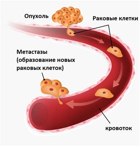 Метастазирование опухоли