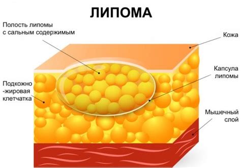 Методы безопасного удаления липомы на спине