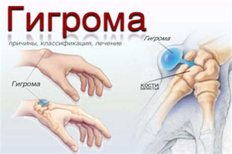 Методы восстановления лучезапястного сустава