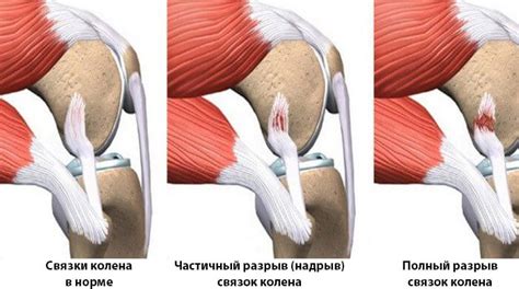 Методы восстановления порванной связки на колене