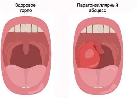 Методы диагностики гноевого отека горла