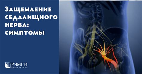 Методы диагностики защемления седалищного нерва