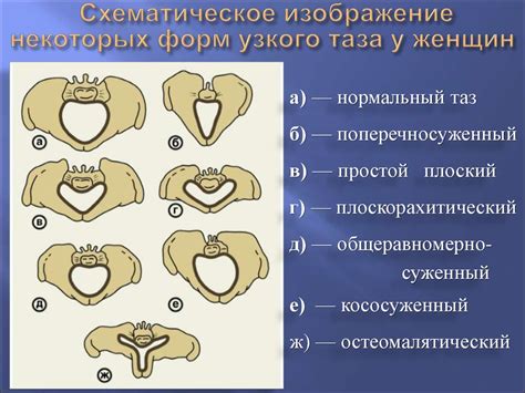 Методы измерения узкого таза