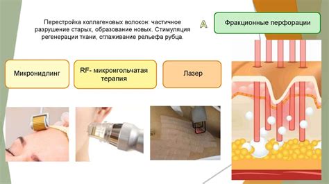 Методы лазерной коррекции рубцов