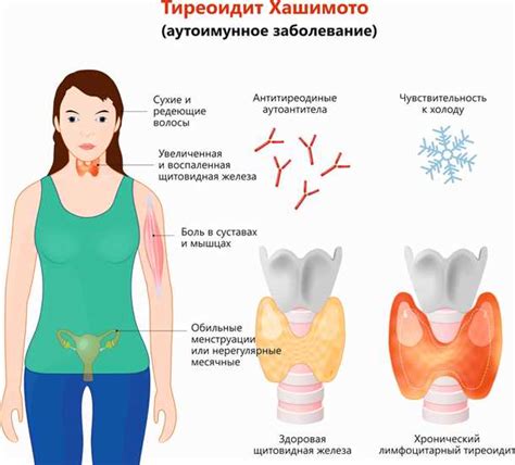 Методы лечения расстройств щитовидной железы