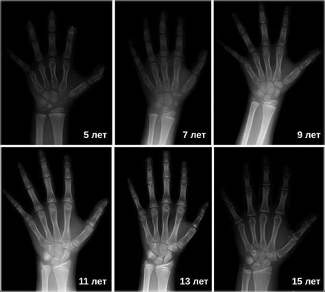 Методы определения костного возраста