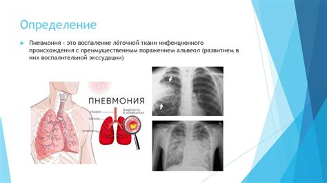 Методы реабилитации после пневмонии