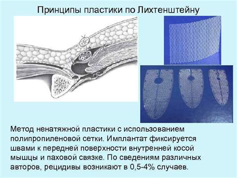 Метод лепестковой пластики