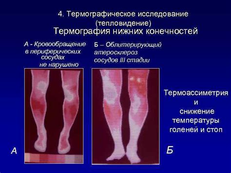 Метод 3: Термографическое исследование