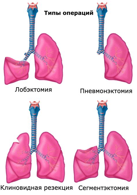 Механизмы развития опухания при раке легкого