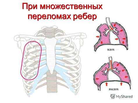 Механическая травма грудной клетки и позвоночника