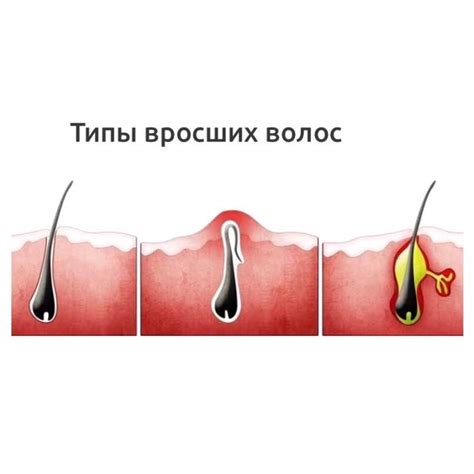 Механическое удаление вросших волос: как сделать это безопасно