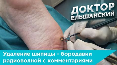 Механическое удаление шипицы