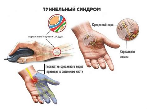 Миозит и туннельный синдром: почему они вызывают боль?