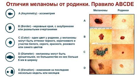 Множественные родинки и их причины