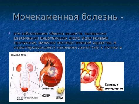 Мочекаменная болезнь: симптомы и причины