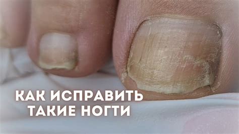 Наличие проблемных ногтей