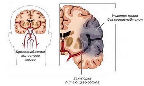 Нарушение кровообращения в головном мозге